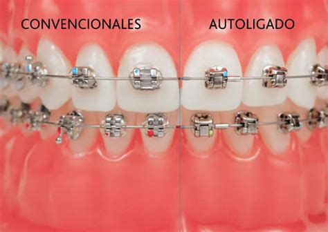 bracket metalicos y esteticos|bracket autoligado vs convencional.